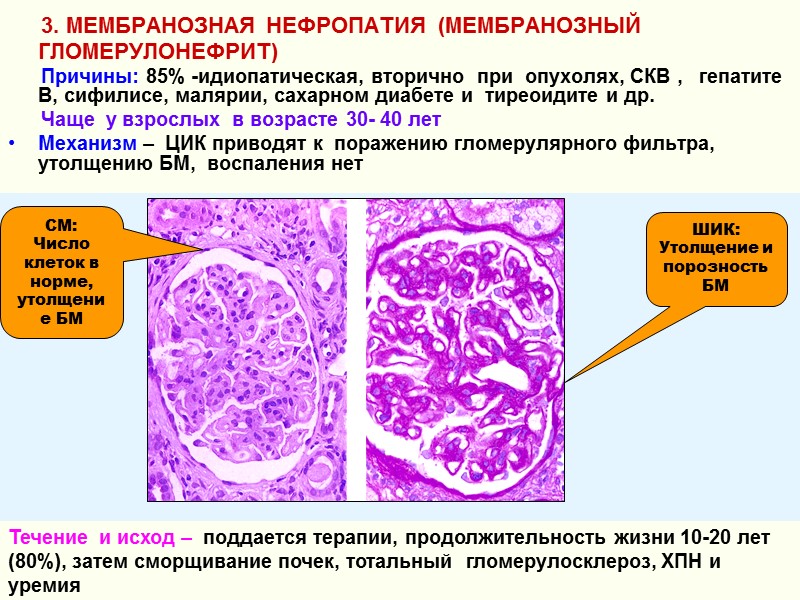3. МЕМБРАНОЗНАЯ НЕФРОПАТИЯ  (МЕМБРАНОЗНЫЙ ГЛОМЕРУЛОНЕФРИТ)       Причины: 85%